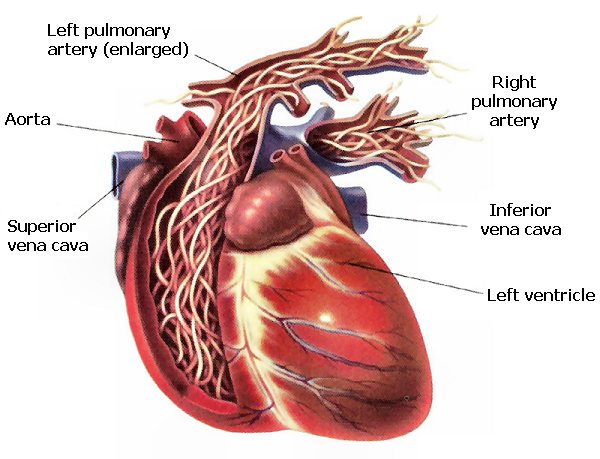 Heartworm in people | Worms \u0026 Germs Blog